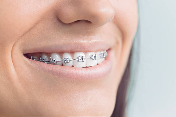 Dental Bonding in Gothenburg, NE